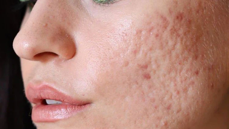 Acne Scar Treatment In Adyar
