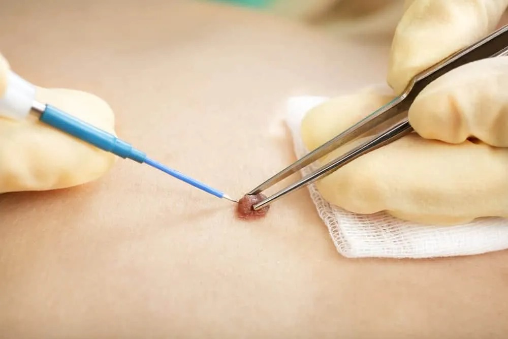 Dermatosurgery clinic in Adyar