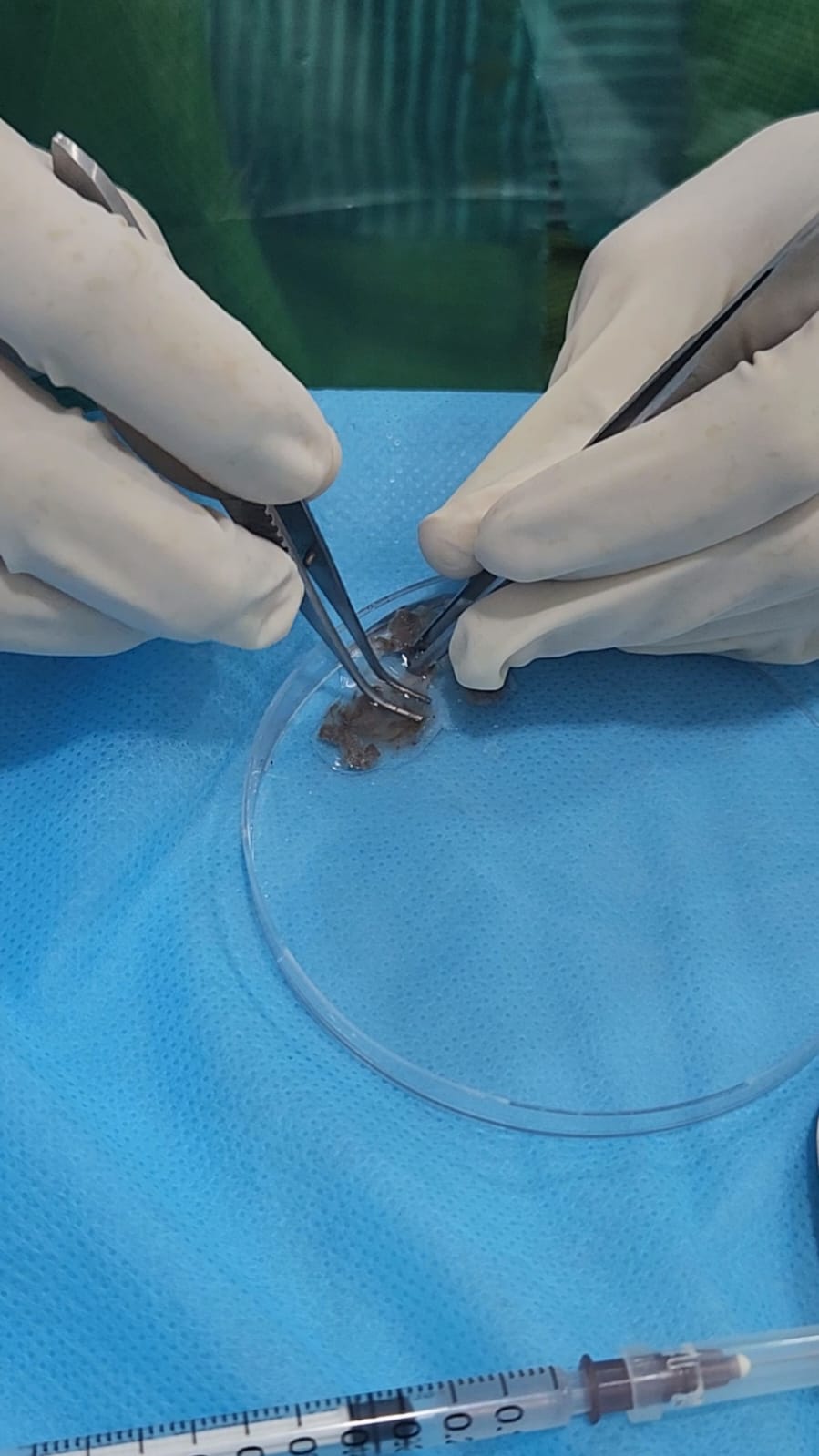 Best Melanocyte Transfer Doctors In Adyar