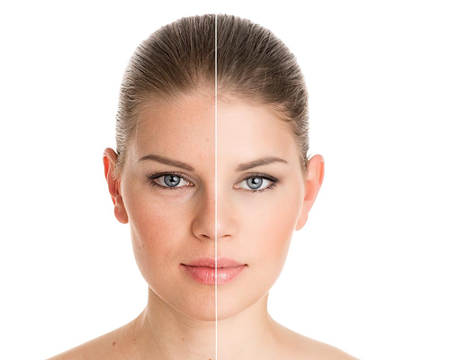 Pigmentation Treatment in Adyar
