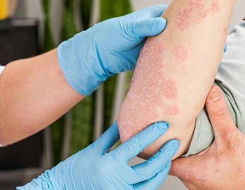 Psoriasis Treatment in Adyar