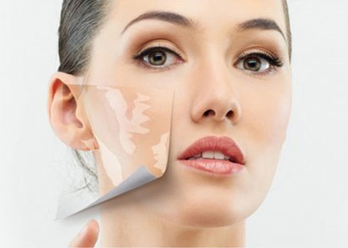 Vitiligo Treatment in Adyar
